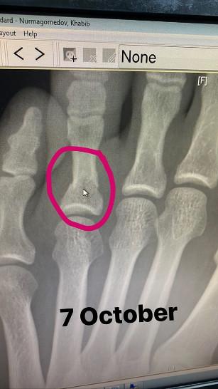 Хабиб показа снимката на счупената кост на стъпалото си 1